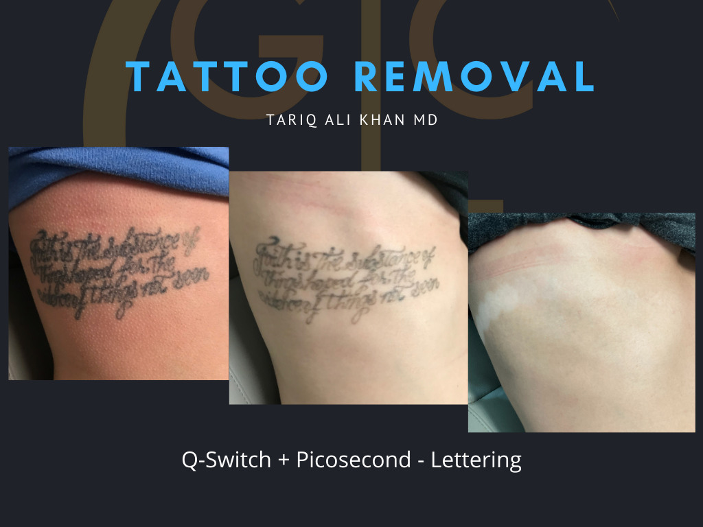 Gentle Care Laser Tustin Before and After picture - Tattoo Removal Mucosal Surface